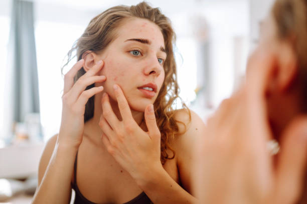 Hormonal Acne Before Your Period: The Science Behind Period Breakouts